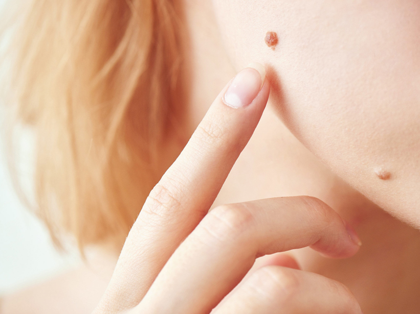 Prevenzione melanoma
